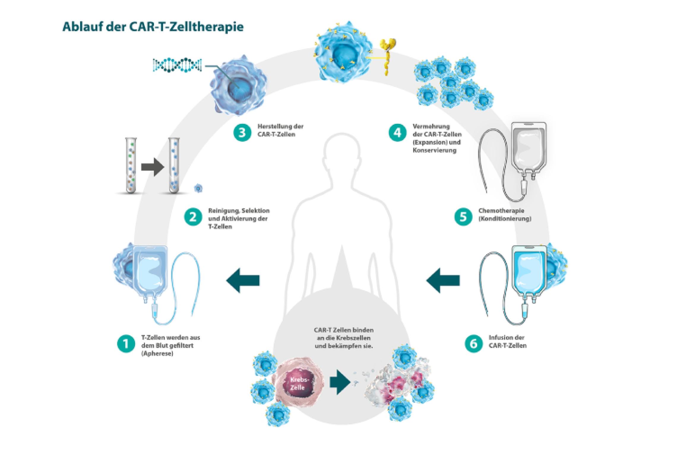 Ablauf CAR-T-Zelltherapie